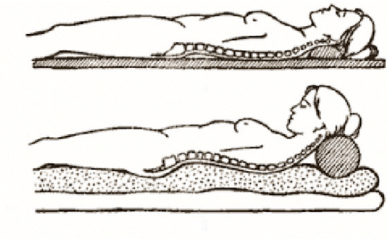 Figur vun osteochendrosos