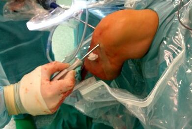Chirurgesch Interventioun fir Arthrosis