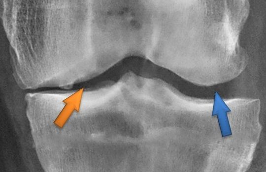 Kinesitherapie fir Arthrosis