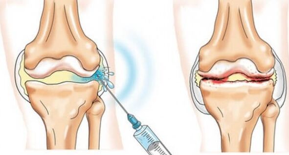 Medizinesch Moossnamen fir Arthrosis