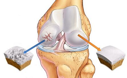 Wat ass Arthrosis vum Knéi Gelenk