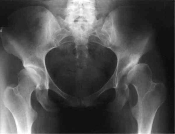 coxarthrosis vum Hip Gelenk op Röntgen